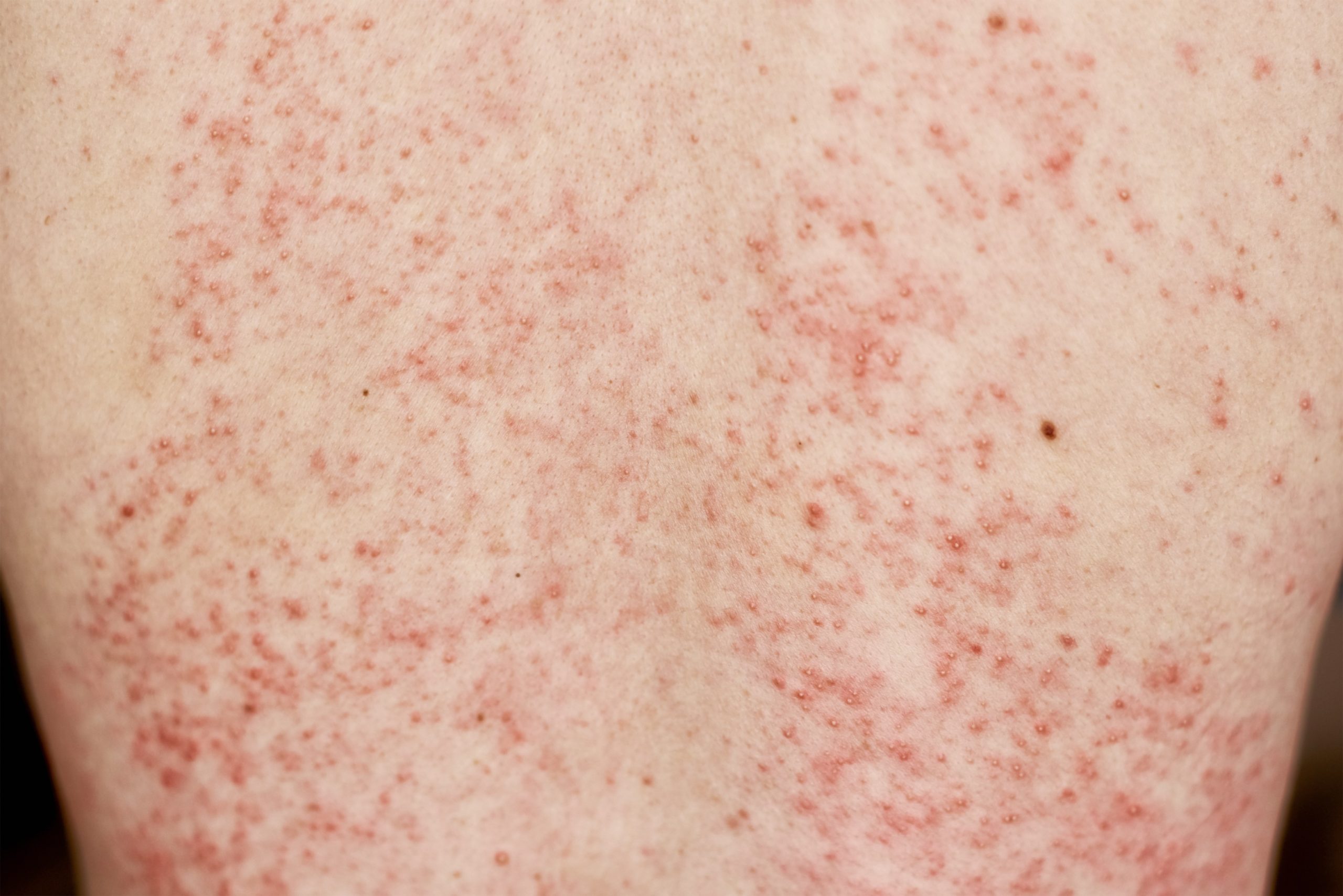 A topical cream for treating shingles that really works